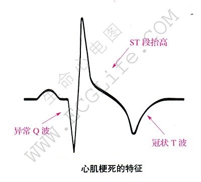 心肌梗死症状的心电图表现