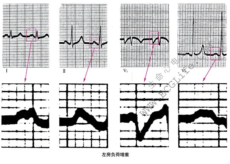 左房负荷增重（LAO）心电图表现