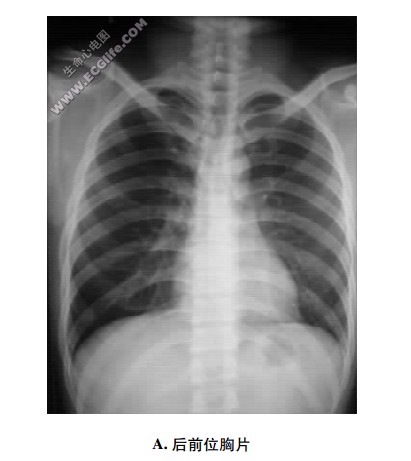 胸片心影解剖：X线摄片检查