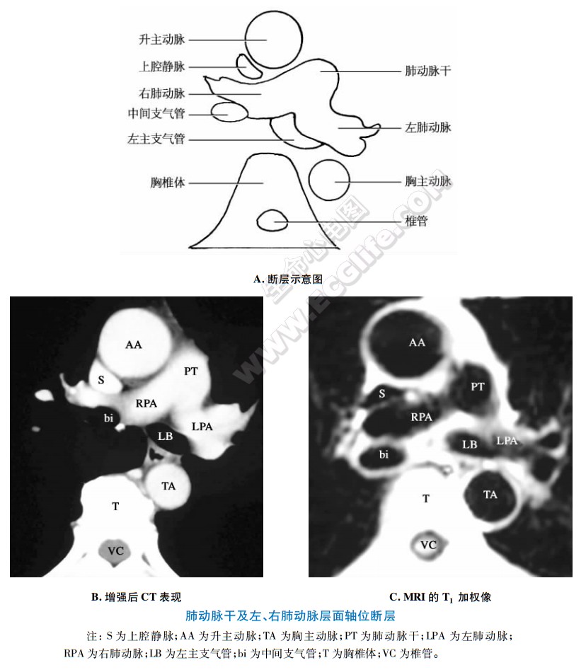 肺动脉干及左,右肺动脉层面ct和mri断层解剖
