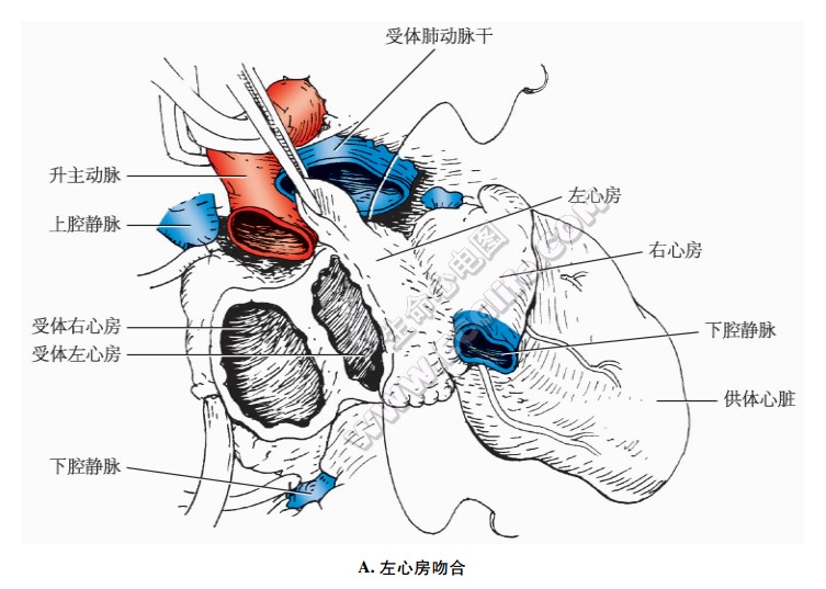 心脏移植：原位、异位、心肺联合移植手术