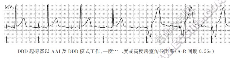 DDD心脏起搏器（心房、心室双腔起搏）