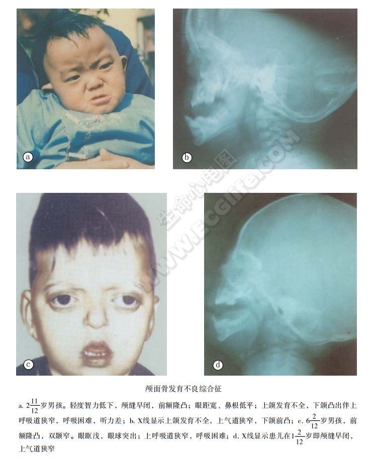 颅面骨发育不良综合征（Crouzon综合征）
