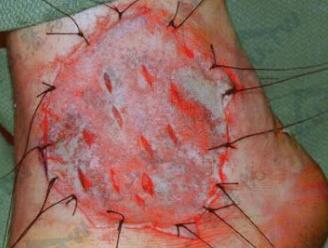 皮肤移植：皮片切取与植皮术