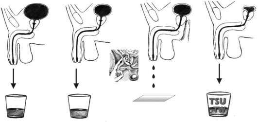 前列腺炎患者要做尿常规吗？需要哪一段尿液做检查？