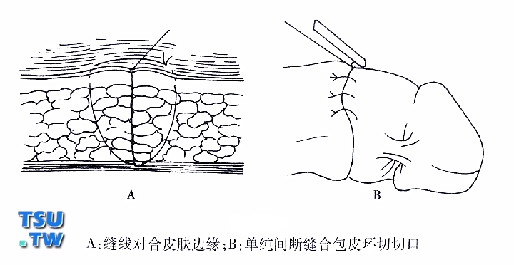 传统割包皮手术的缝合方法总结