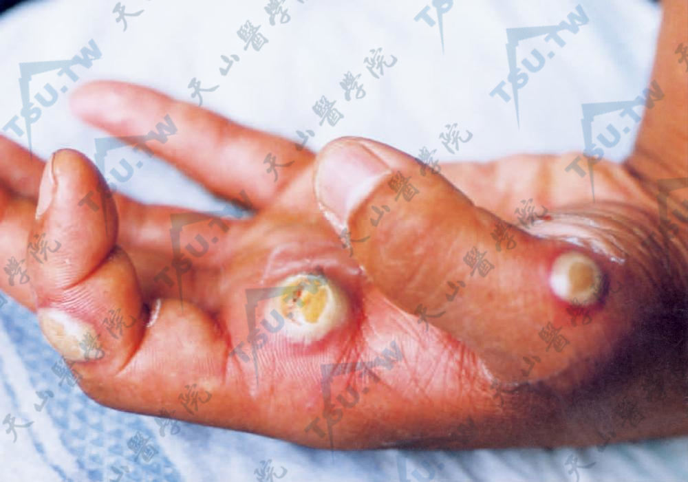 羊痘（Orf、传染性脓疱性皮炎）病因、症状、诊疗参考