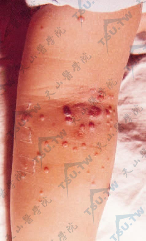传染性软疣（Molluscum Contagiosum）病因、症状、诊疗