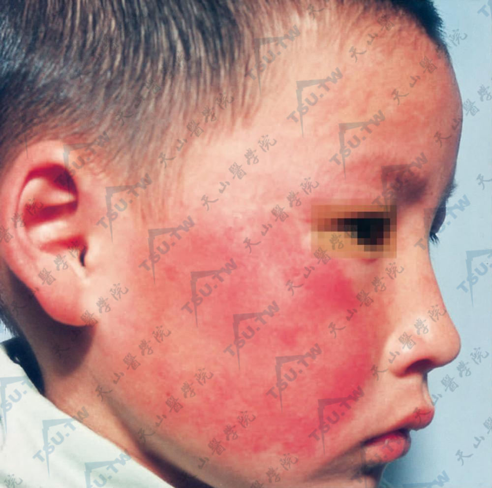 传染性红斑（Erythema Infectiosum、第五种病）