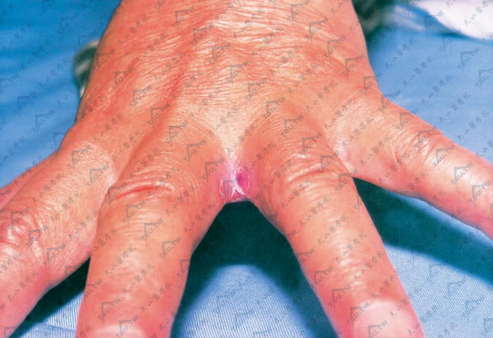 手癣/鹅掌疯：红色毛癣菌为主的真菌感染