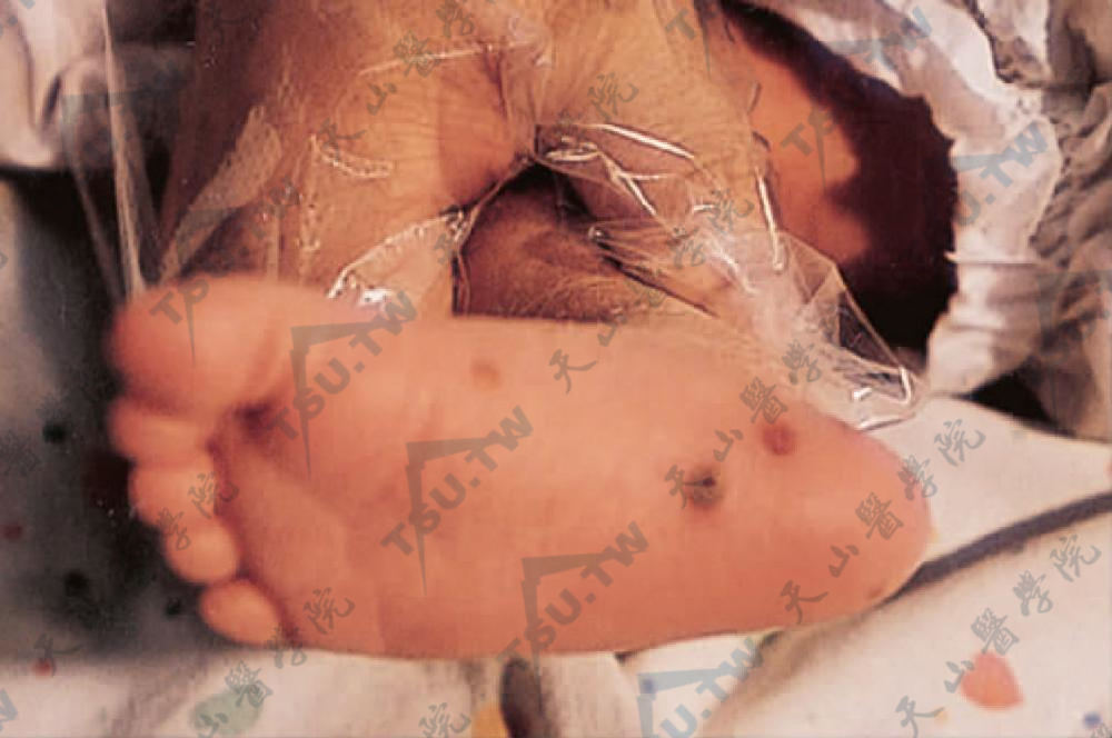 新生儿暂时性脓疱性黑变病