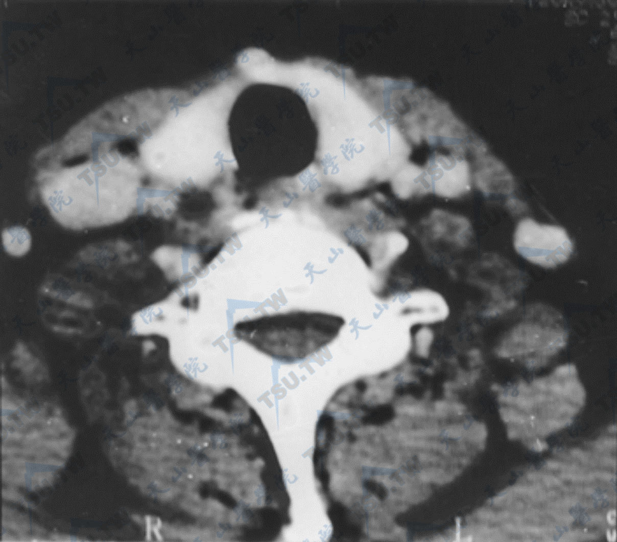甲状腺-甲状旁腺CT