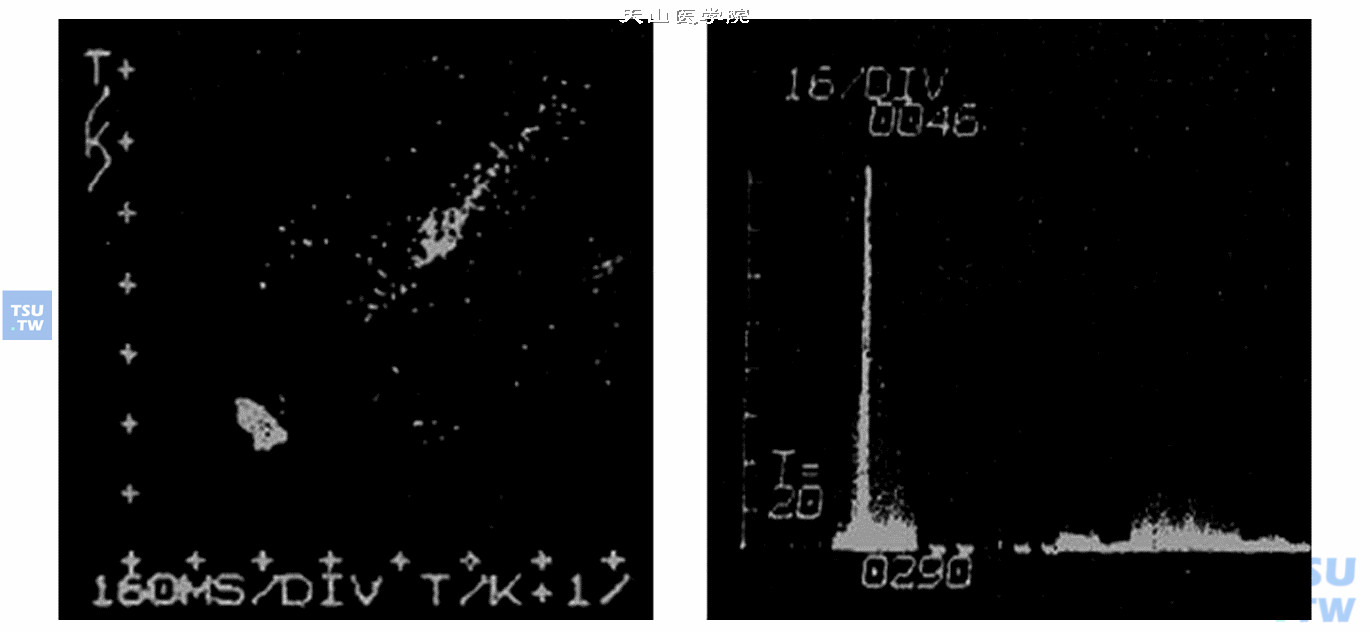  同一间歇性心动过速病人的联合时距直方图（左）与直方图（右）［引自M edical progress through technology，1977，5（3）：149-156］