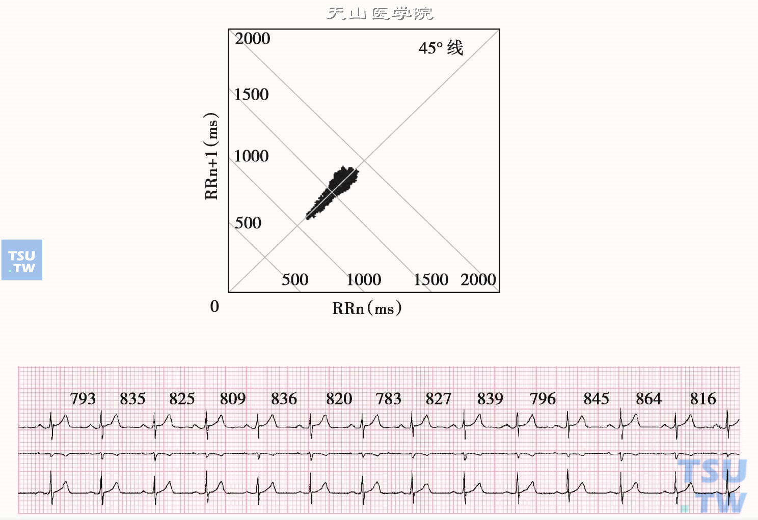 窦性心律及窦性心律失常的心电散点图
