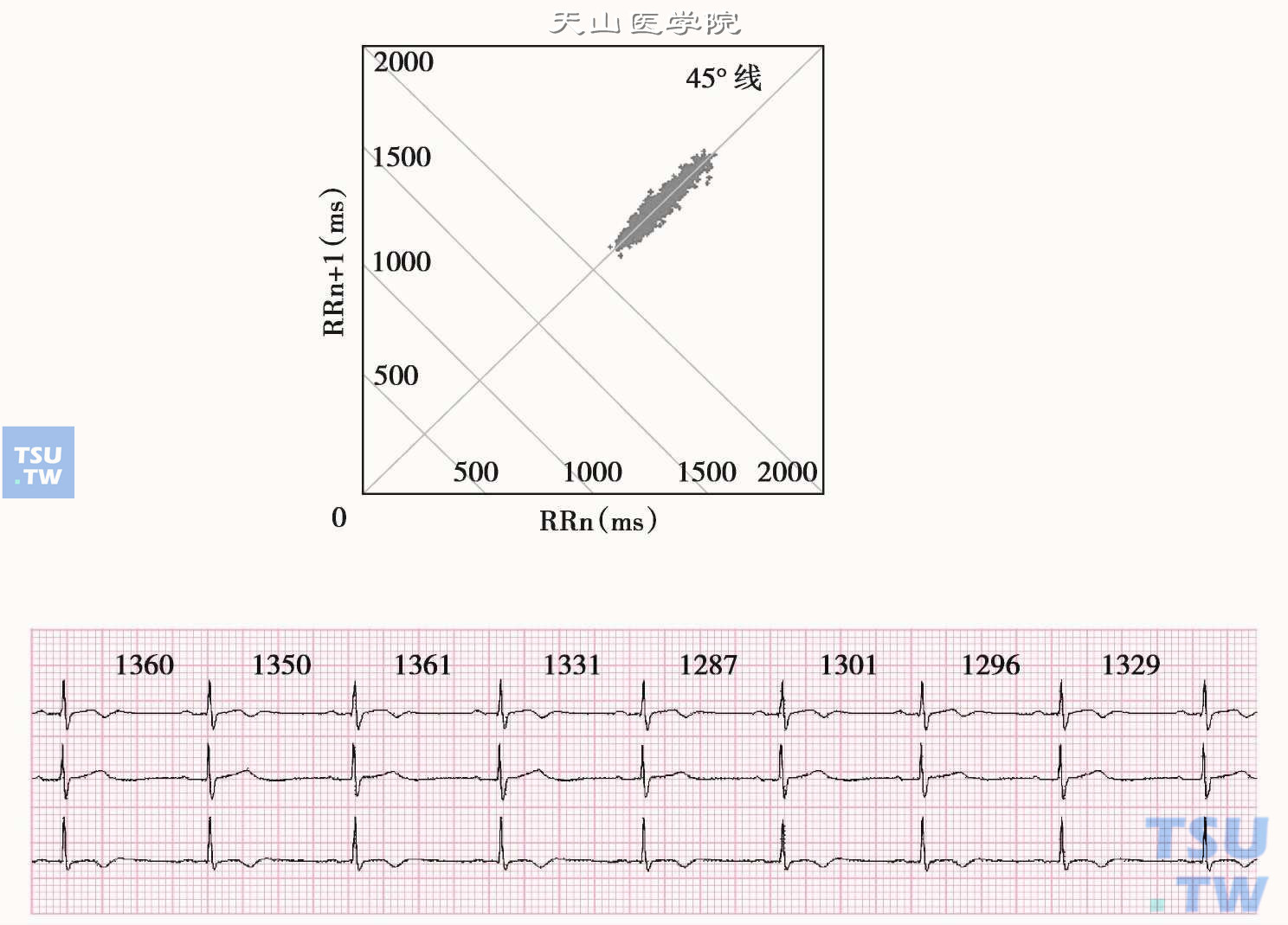  窦性心动过缓：上图为1小时的心电散点图，图形分布于45°线远端，呈棒状。