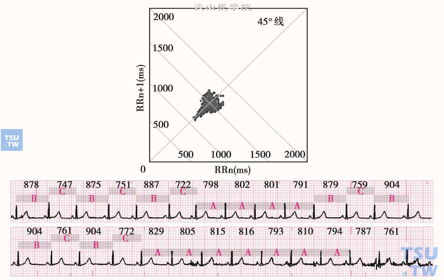 窦性逸搏：图为1小时的心电散点图