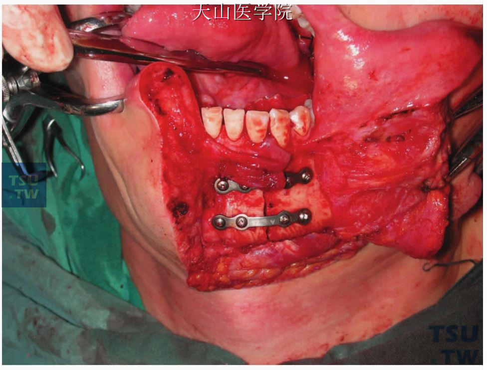 腮腺深叶肿瘤及咽侧小唾液腺肿瘤切除术