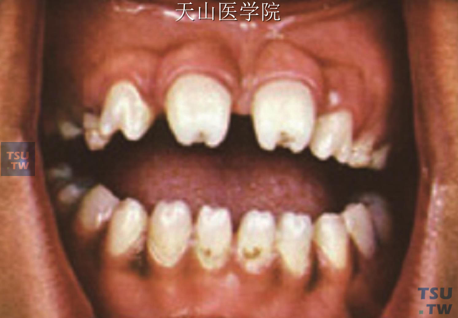 先天性梅毒牙