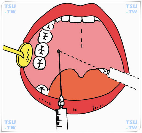 阻滞麻醉法：上牙槽后神经、腭前、上颌、下牙槽神经注射