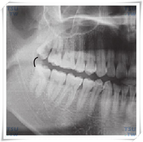 智齿牙龈切术+去骨术