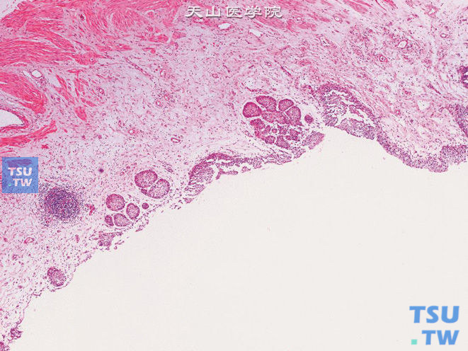 肾盂增生：脂肪瘤样增生、纤维上皮样息肉、黏膜上皮增生和Brunn巢