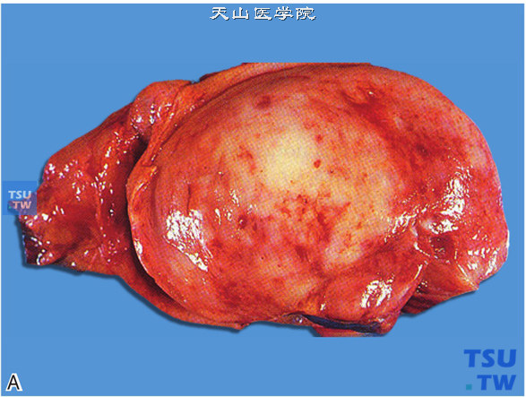 睾丸淋巴细胞和血液系统肿瘤