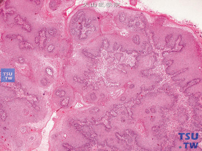 阴茎鳞状上皮低分级乳头状癌,示复杂的乳头状结构