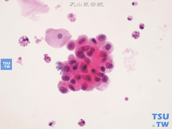 病理一：膀胱癌尿路上皮癌尿细胞学图谱