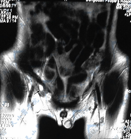 隐睾的MRI（磁共振成像）扫描现象