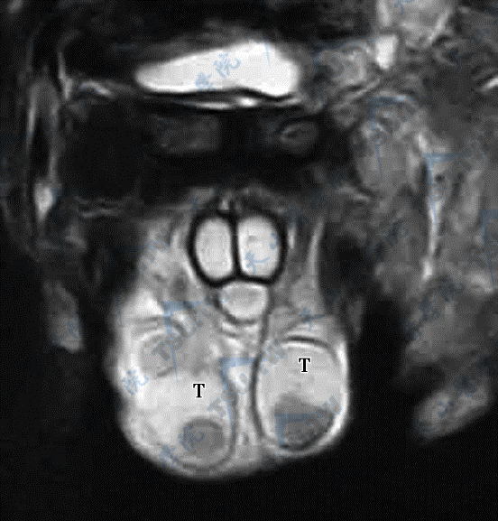 附睾及睾丸结核的CT和磁共振现象图解
