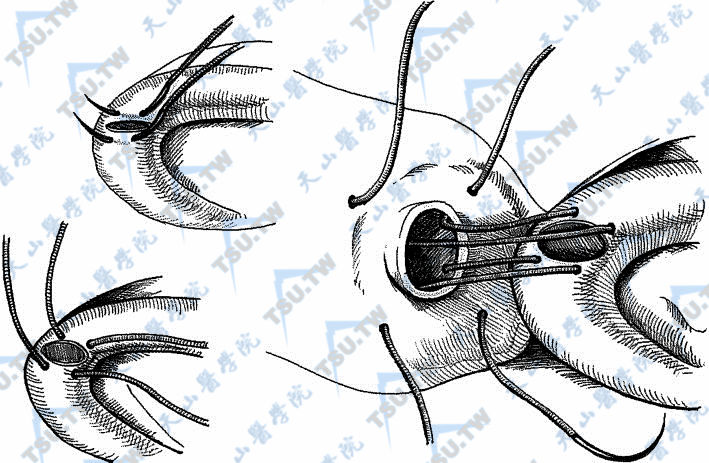 显微输精管附睾端侧吻合术（横形两针套入法）