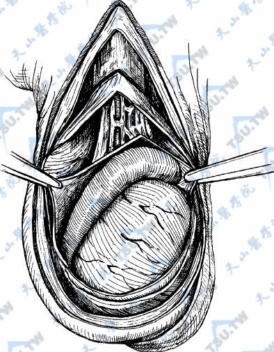 认识阴囊：形状结构、血管、神经和淋巴管
