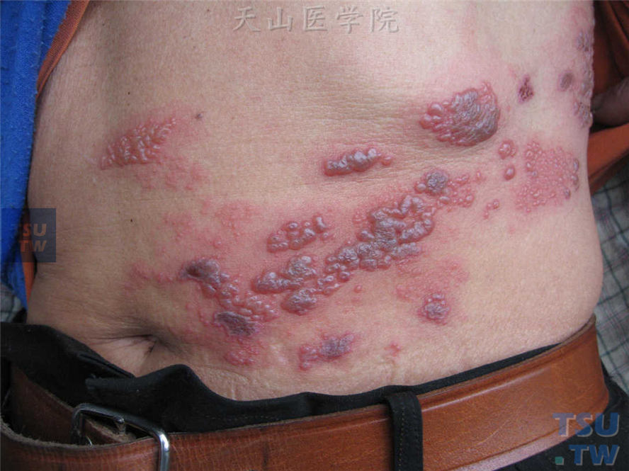 【图】带状疱疹(herpes zoster)症状表现 皮肤病诊断图谱 天山