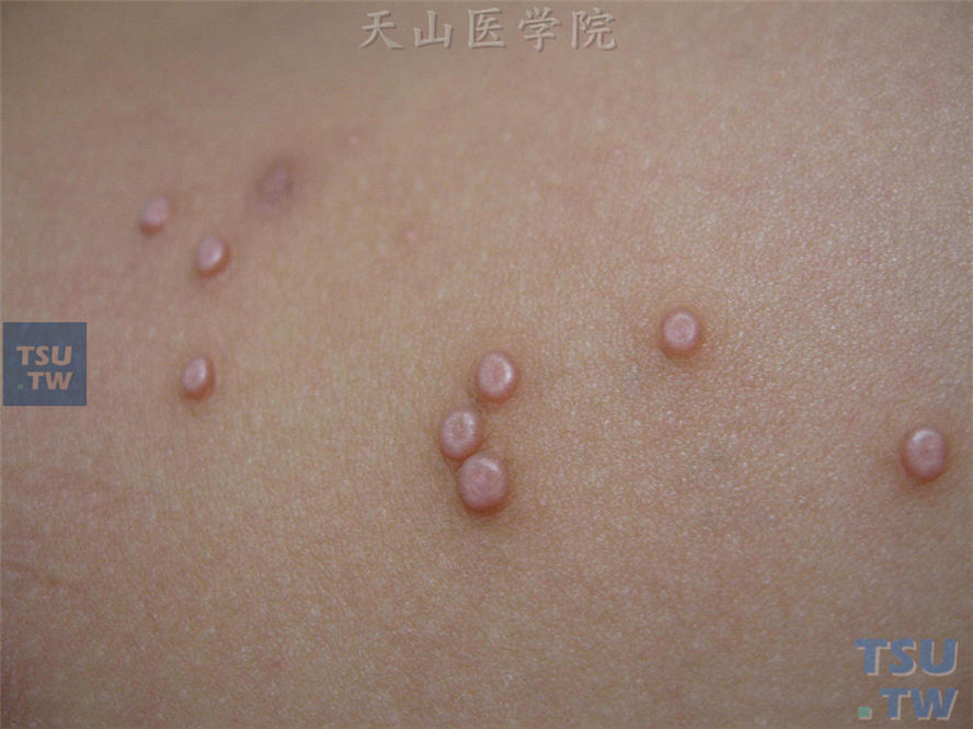 半球形的丘疹,正常肤色或珍珠色,表面光滑,中央脐凹