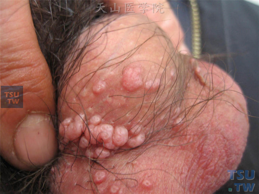 传染性软疣（molluscum contagiosum）症状表现