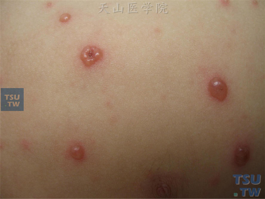 水痘（varicella）症状表现