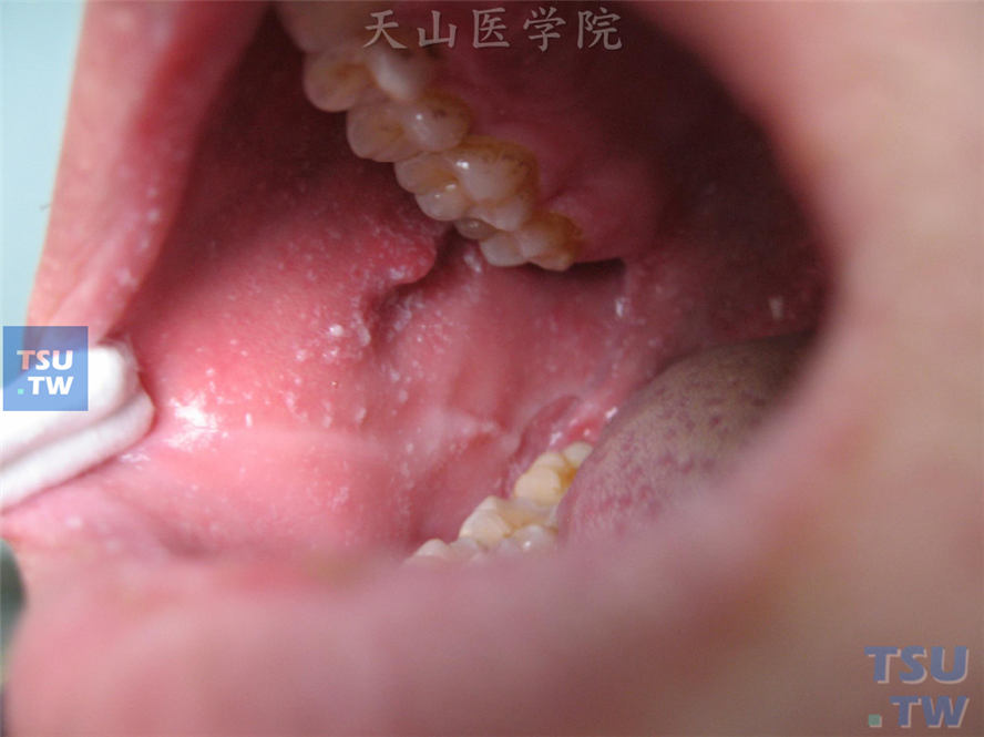 同一病人,颊黏膜koplik斑:第二臼齿对面的颊黏膜上蓝白色或紫色小点