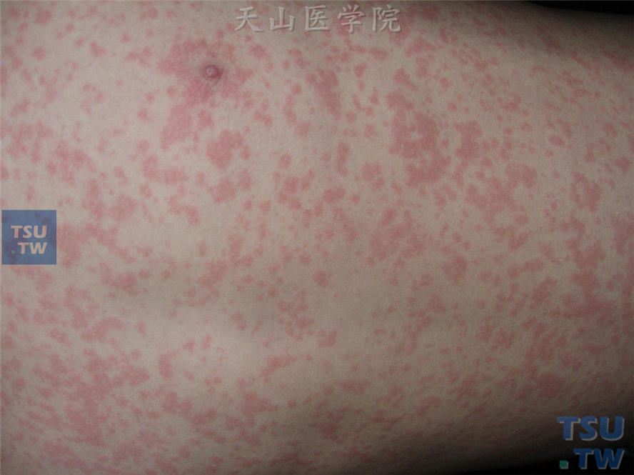 麻疹（measles）症状表现