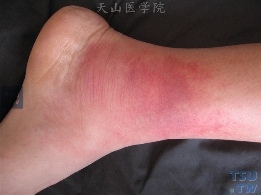 有足癣病史,足踝,足背水肿性红斑,触痛,皮温增高