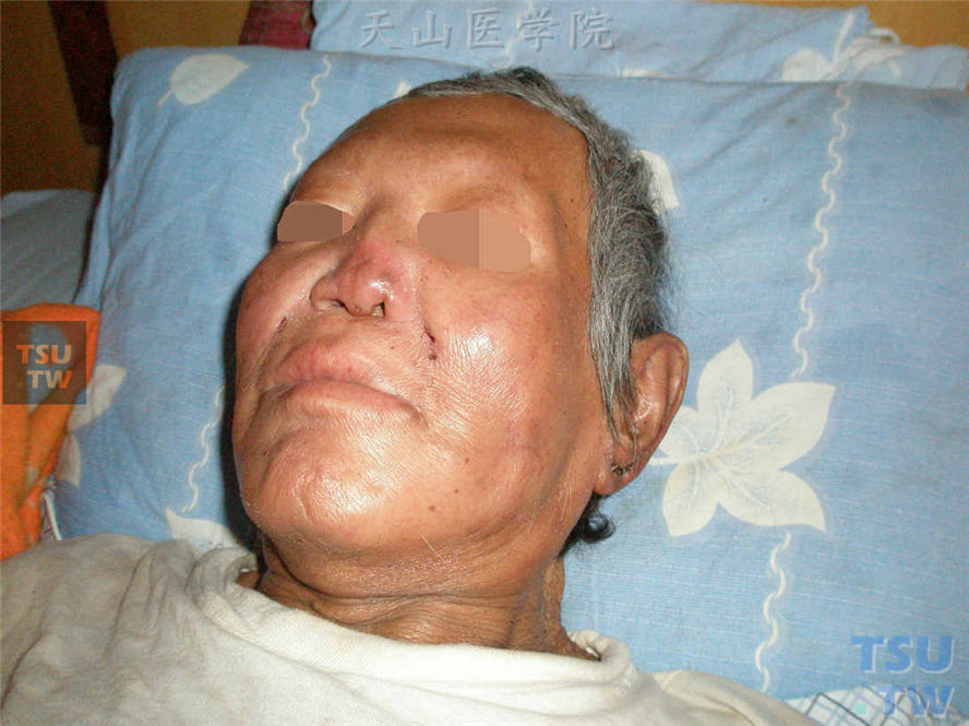 瘤型麻风(leprosy)的症状表现