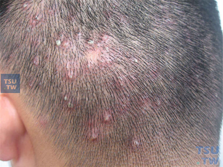 加之金黄色葡萄球菌感染,导致毛囊部被破坏,而形成永久性脱发的毛囊炎