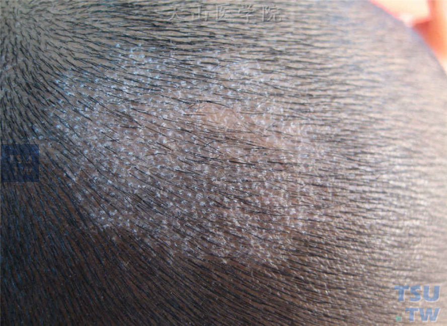 头癣（tinea capitis）的症状表现