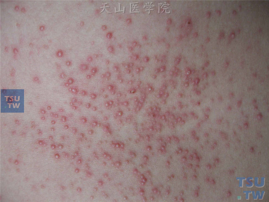 马拉色菌毛囊炎（malassezia folliculitis）的症状表现