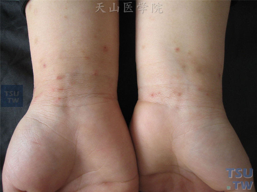 【图】疥疮(scabies)的症状表现 - 皮肤病诊断图谱