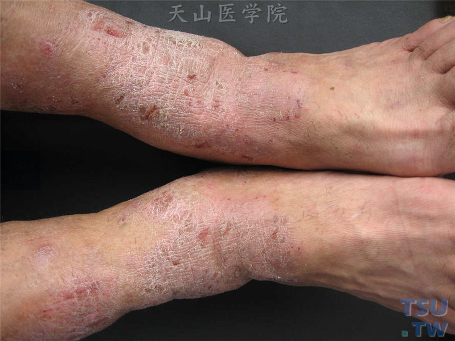 慢性湿疹:双踝关节屈侧苔藓样变,皮损浸润肥厚,表面粗糙,皮沟加深,皮
