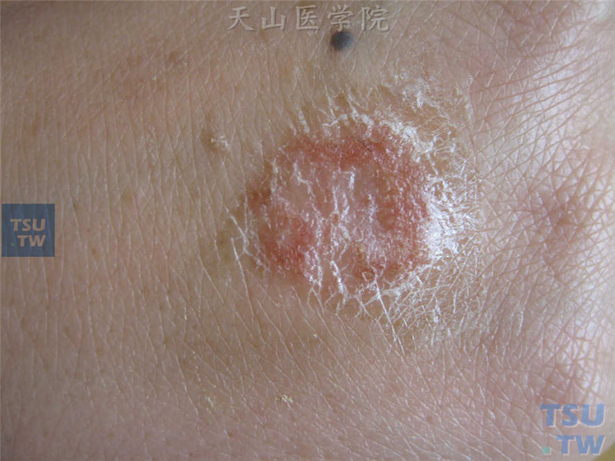 湿疹（eczema）的症状表现