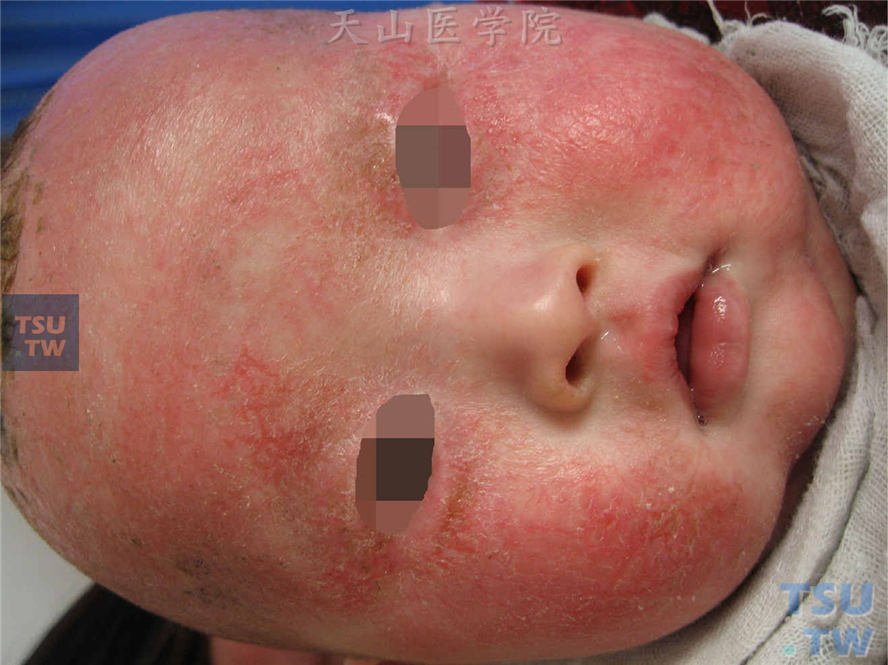 婴儿湿疹（infantile eczema）的症状表现