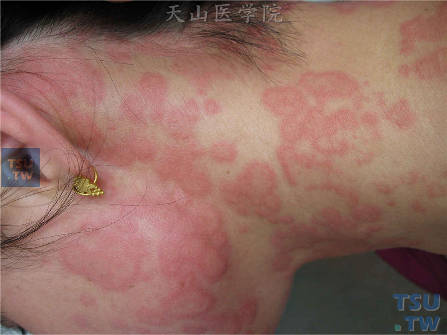 荨麻疹型药疹（urticaria drug eruption）的症状表现