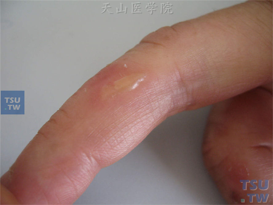 摩擦性水疱（friction blisters）的症状表现