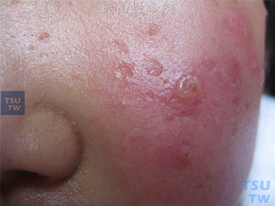 种痘样水疱病（hydroa vacciniforme）的症状表现